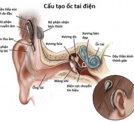 Cấy ốc tai điện tử: Những điều cần biết