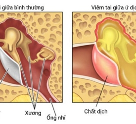 Viêm tai ứ dịch – Nguyên nhân khiến trẻ chậm phát triển ngôn ngữ