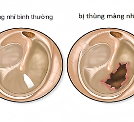 PHÒNG NGỪA THỦNG MÀNG NHĨ 