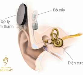 QUÁ TRÌNH THỰC HIỆN CẤY GHÉP ỐC TAI ĐIỆN TỬ  NHƯ THẾ NÀO?