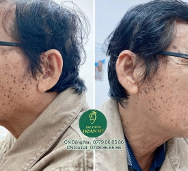 Lý do nên đeo máy trợ thính 2 bên